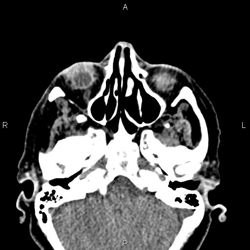 Bilateral enlargement of lacrimal glands - sarcoidosis (Radiopaedia 62627-70921 Axial non-contrast 27).jpg