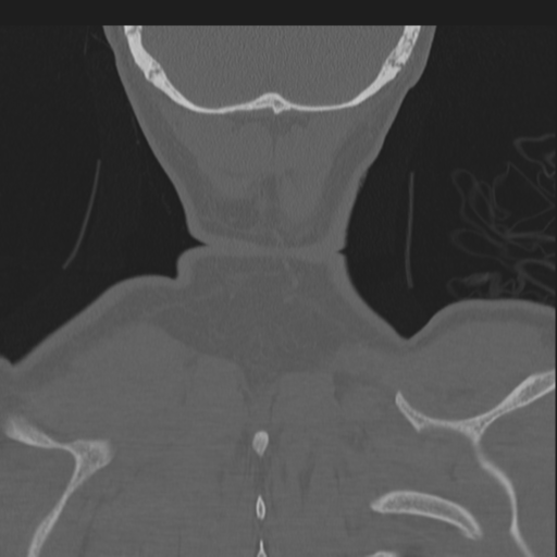 File:Bilateral locked facets (Radiopaedia 33850-35016 Coronal bone window 86).png