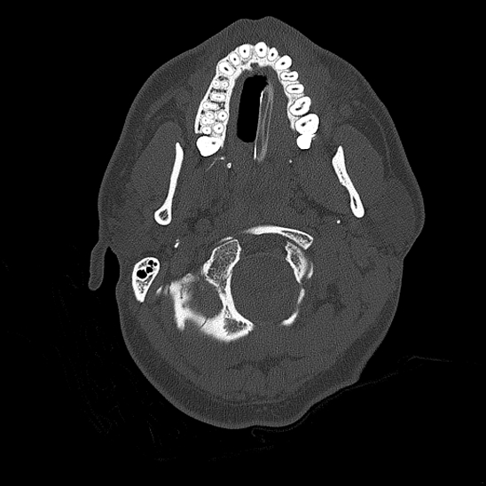 Bilateral occipital condyle fracture (type 2) (Radiopaedia 87675-104089 Axial bone thins 9).jpg
