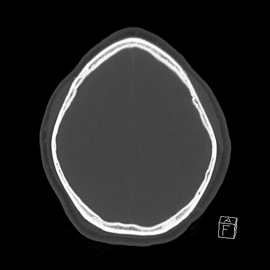 Bilateral occipital condyle fracture (type 2) (Radiopaedia 87675-104089 Axial bone window 104).jpg