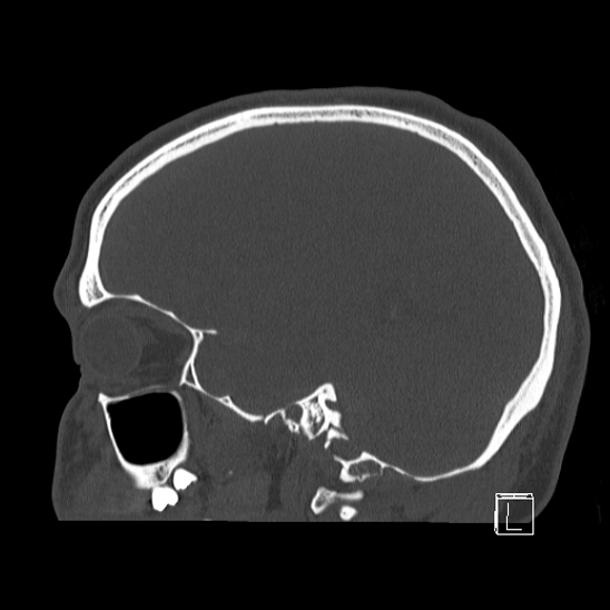 Bilateral occipital condyle fracture (type 2) (Radiopaedia 87675-104089 Sagittal bone window 29).jpg