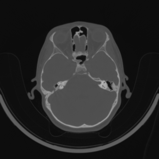Bilateral otosclerosis (Radiopaedia 57237-64157 C 57).jpg