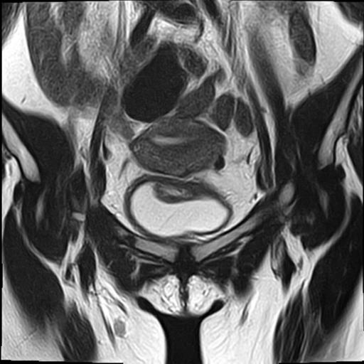 File:Bilateral ovarian endometriomas (Radiopaedia 87085-103347 Coronal T2 5).jpg