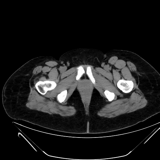 Bilateral ovarian mature cystic teratomas (Radiopaedia 79373-92457 Axial non-contrast 97).jpg
