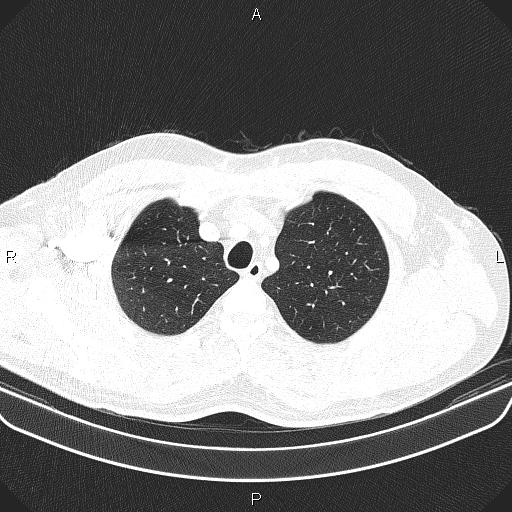 File:Bilateral pulmonary AVM (Radiopaedia 83134-97505 Axial lung window 15).jpg