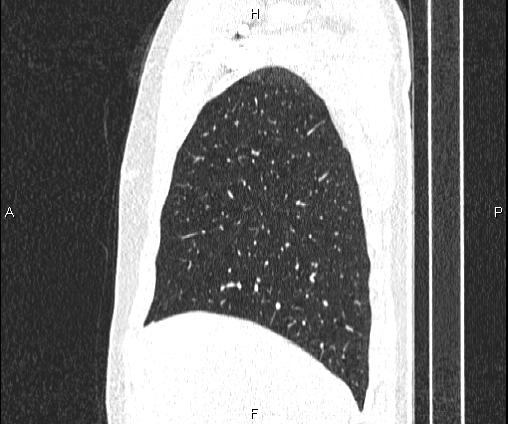Bilateral pulmonary AVM (Radiopaedia 83134-97505 Sagittal lung window 30).jpg