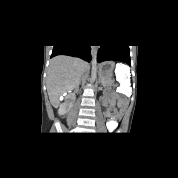 File:Bilateral renal malrotation (Radiopaedia 30901-31606 B 8).jpg