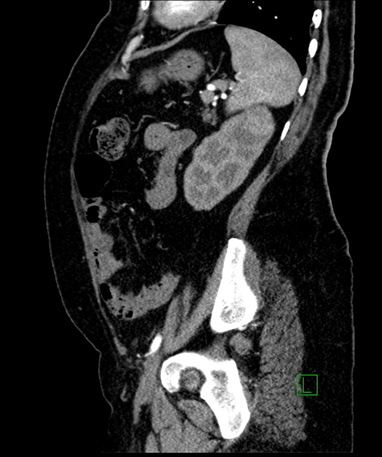 Bilateral sporadic synchronous clear cell renal cell carcinoma (Radiopaedia 85035-100575 E 39).jpg