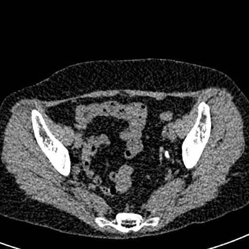 Bilateral staghorn calculi (Radiopaedia 59475-66842 Axial non-contrast 69).jpg