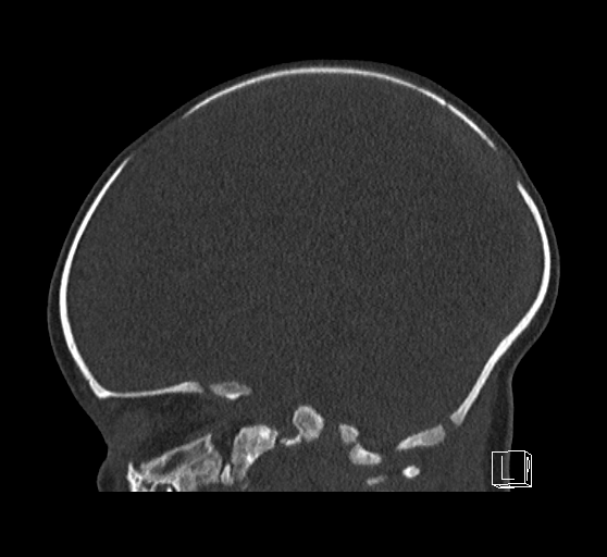 Bilateral subdural hemorrhage and parietal skull fracture (Radiopaedia 26058-26192 Sagittal bone window 39).png