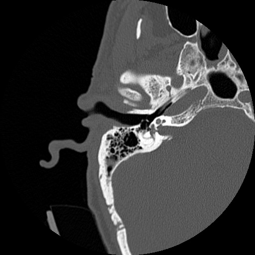 File:Bilateral temporal bone fractures (Radiopaedia 29482-29970 Axial non-contrast 18).jpg