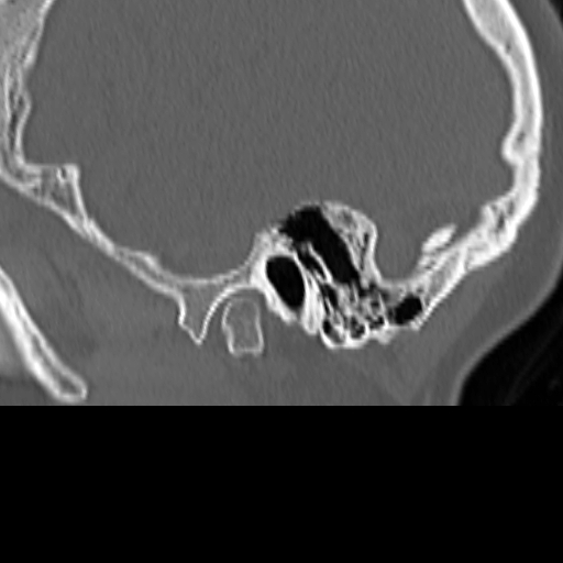 Bilateral tympanoplasty (Radiopaedia 16947-16664 Sagittal bone window 7).jpg
