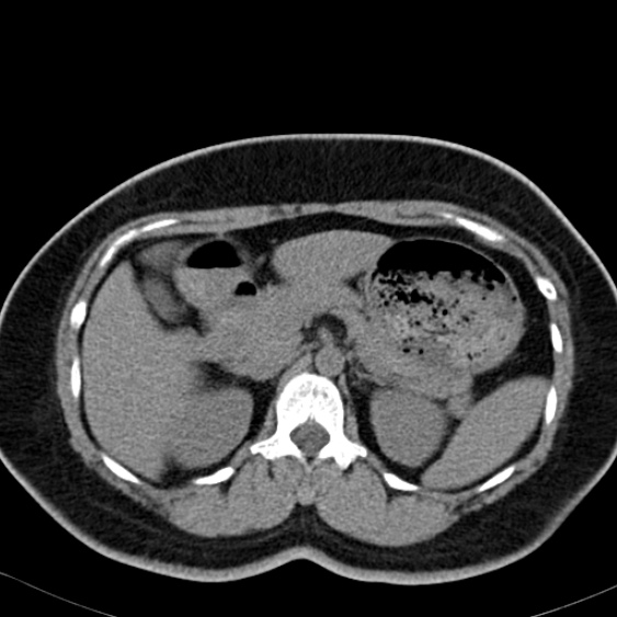 Bilateral ureteric stents (Radiopaedia 48795-53825 Axial non-contrast 16).jpg
