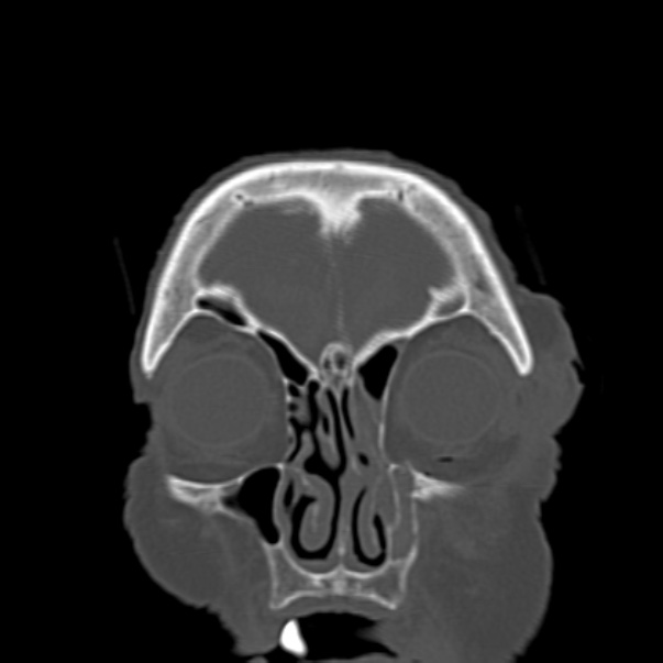 Biparietal osteodystrophy (Radiopaedia 46109-50463 Coronal bone window 21).jpg