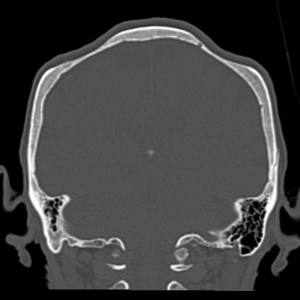 Biparietal osteodystrophy (Radiopaedia 46109-50463 Coronal bone window 70).jpg