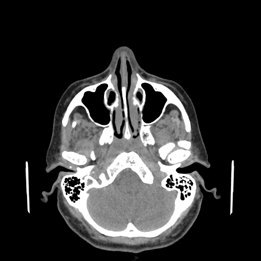 Bisphosphonate-related osteonecrosis of the jaw (Radiopaedia 71324-81642 non-contrast 147).jpg