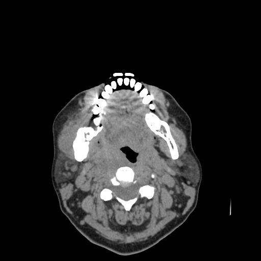 Bisphosphonate-related osteonecrosis of the jaw (Radiopaedia 71324-81642 non-contrast 68).jpg