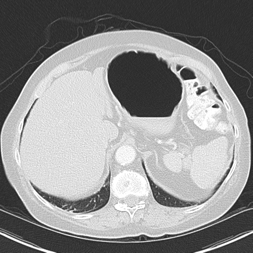 File:Bladder and bowel cancers (Radiopaedia 37688-39592 Axial lung window 48).png