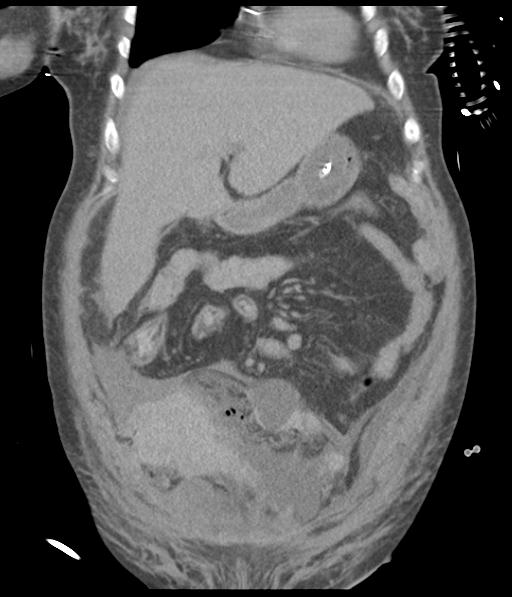 Bladder rupture post renal biopsy (Radiopaedia 30863-31572 Coronal non-contrast 20).jpg