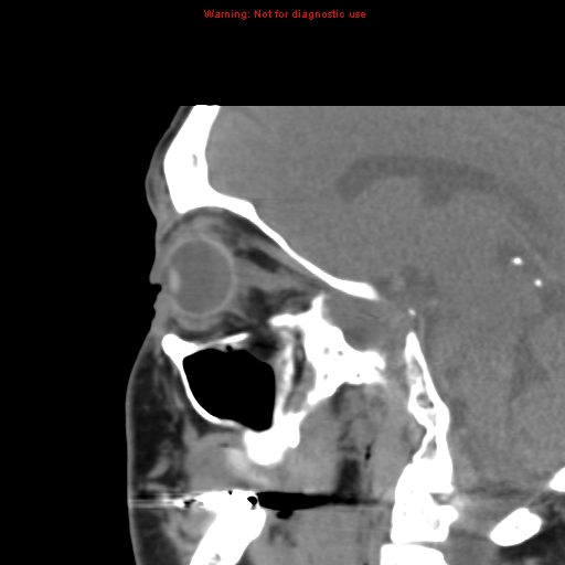File:Blowout fracture with inferior rectus entrapment (Radiopaedia 12418-12673 C 10).jpg