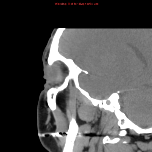 File:Blowout fracture with inferior rectus entrapment (Radiopaedia 12418-12673 C 3).jpg