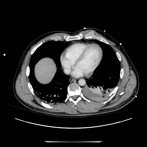 Blunt abdominal trauma with solid organ and musculoskelatal injury with active extravasation (Radiopaedia 68364-77895 A 4).jpg