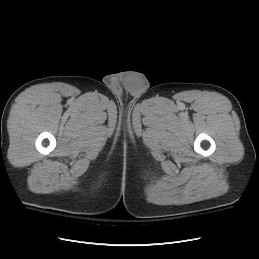 File:Blunt abdominal trauma with solid organ and musculoskelatal injury with active extravasation (Radiopaedia 68364-77895 Axial C+ delayed 162).jpg
