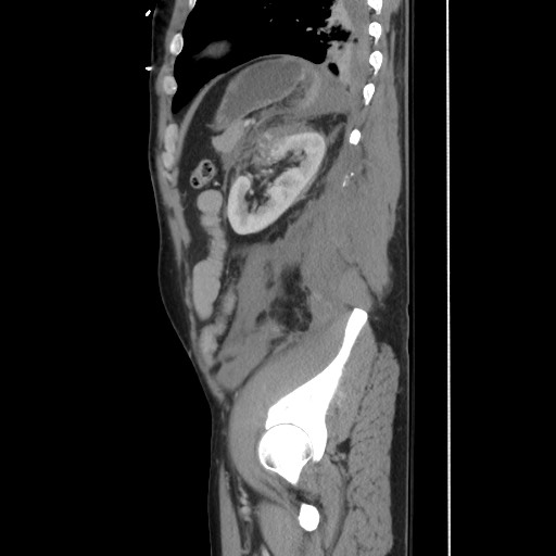 Blunt abdominal trauma with solid organ and musculoskelatal injury with active extravasation (Radiopaedia 68364-77895 C 108).jpg