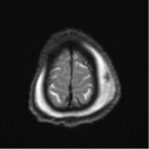 Blunt cerebrovascular injury (Radiopaedia 53682-59745 Axial DWI 27).png