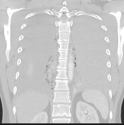 Boerhaave syndrome (Radiopaedia 39382-41661 Coronal lung window 37).png