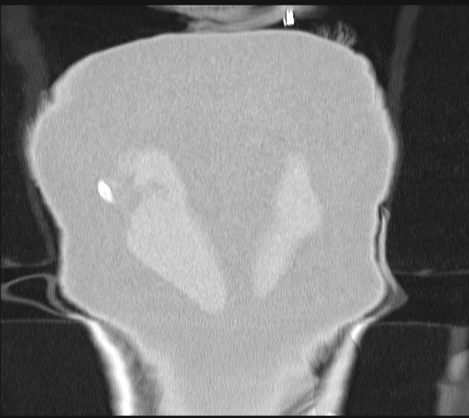 Boerhaave syndrome (Radiopaedia 45644-49799 Coronal lung window 71).jpg