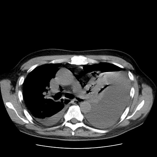 Boerhaave syndrome (Radiopaedia 59796-67310 Axial liver window 27).jpg