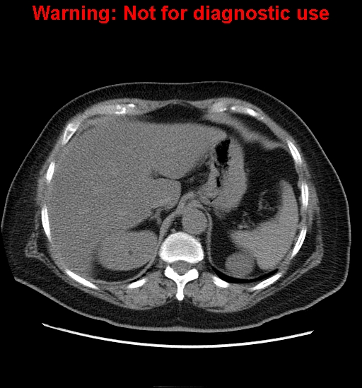 File:Bosniak renal cyst - type II (Radiopaedia 23404-23468 Axial non-contrast 1).jpg
