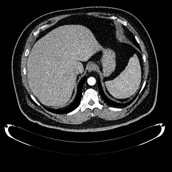 Bosniak renal cyst - type IV (Radiopaedia 24244-24518 B 49).jpg