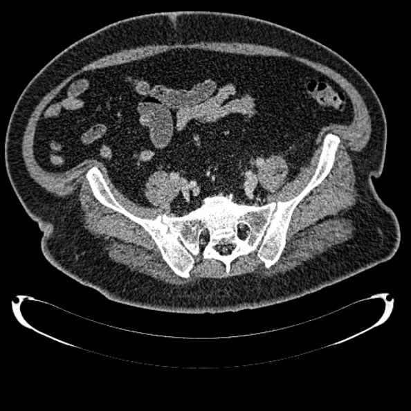 Bosniak renal cyst - type IV (Radiopaedia 24244-24518 C 299).jpg