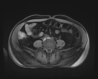 Bouveret syndrome (Radiopaedia 61017-68856 Axial T1 fat sat 66).jpg