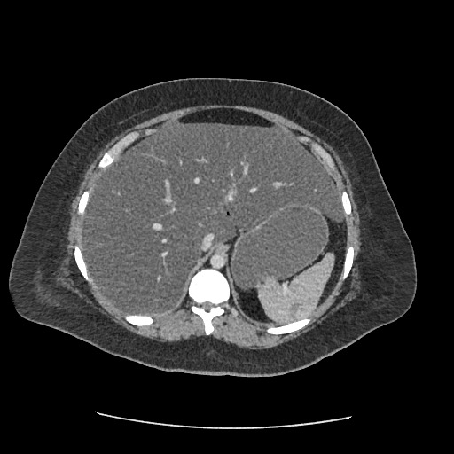 Bowel and splenic infarcts in acute lymphocytic leukemia (Radiopaedia 61055-68915 A 36).jpg