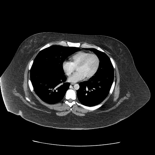 Bowel and splenic infarcts in acute lymphocytic leukemia (Radiopaedia 61055-68915 A 9).jpg