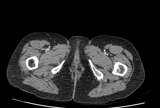 Bowel perforation at ERCP (Radiopaedia 59094-66394 C 75).jpg