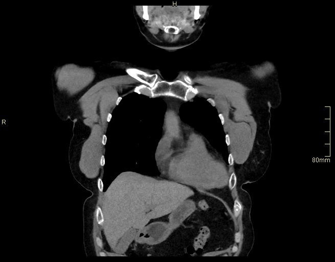 Brachial artery foreign body (Radiopaedia 54583-60820 Coronal non-contrast 12).jpg