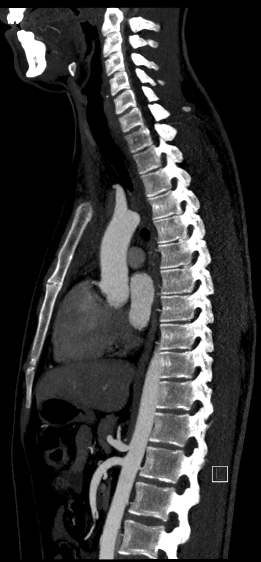 Brachiocephalic trunk pseudoaneurysm (Radiopaedia 70978-81191 C 51).jpg