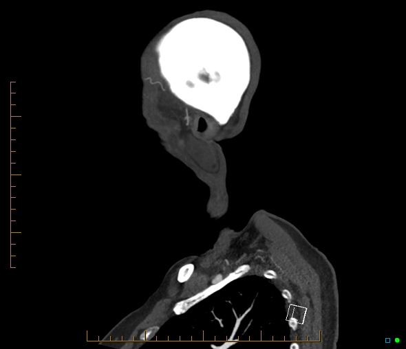 Brachiocephalic trunk stenosis (Radiopaedia 87242-103519 C 3).jpg
