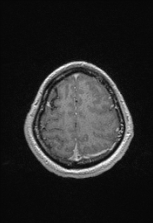 Brain abscess with ventriculitis (Radiopaedia 85703-101495 Axial T1 C+ 144).jpg