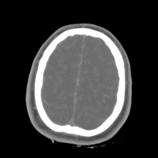 Brain contusions, internal carotid artery dissection and base of skull fracture (Radiopaedia 34089-35339 D 11).png