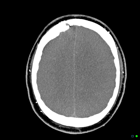 Brain death on MRI and CT angiography (Radiopaedia 42560-45841 B 17).jpg