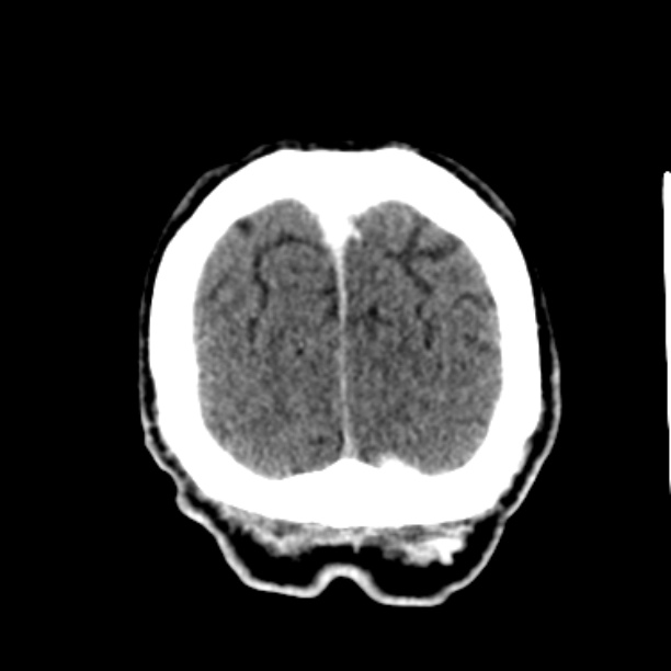 Brain metastases from lung cancer (Radiopaedia 27849-28092 Coronal C+ delayed 63).jpg