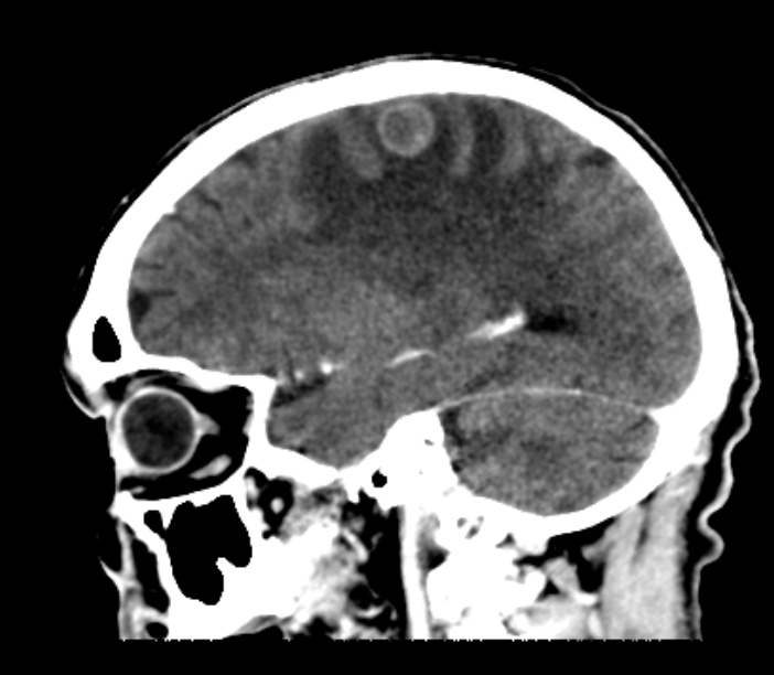 Brain metastases from lung cancer (Radiopaedia 27849-28092 Sagittal C+ delayed 21).jpg