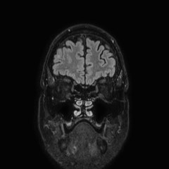 File:Brain metastases from lung cancer (Radiopaedia 83839-99028 Coronal FLAIR 10).jpg