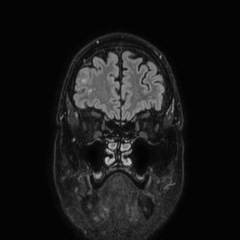 Brain metastases from lung cancer (Radiopaedia 83839-99028 Coronal FLAIR 11).jpg