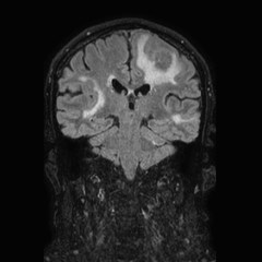 Brain metastases from lung cancer (Radiopaedia 83839-99028 Coronal FLAIR 47).jpg